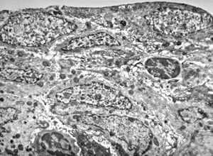 M,18y. | immotile cilia syndrome - bronchus